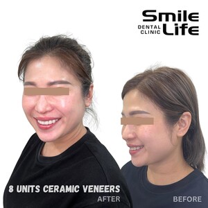 Image of Ceramic veneers