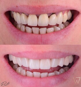 Image of Before and after smile makeover