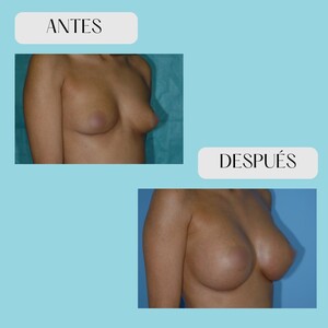 Image of Breast Implant - Millan Mateo Institute