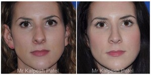 Image of London Rhinoplasty Gallery 2