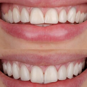 Image of Veneers - Dentelli