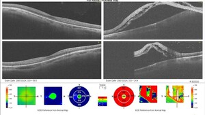 Image of Retinal Detachment Surgery BEFORE