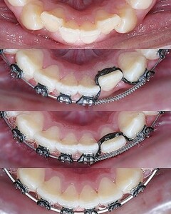 Image of Braces