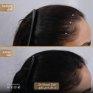 Image of Beauty Elements Clinics offers advanced hair loss treatments for effective and lasting results.