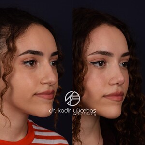 Image of Nose job - Dr. Kadir Yücebaş