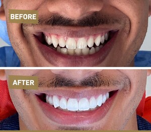 Image of Hollywood smile results