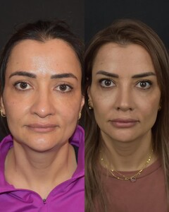 Image of Rhinoplasty