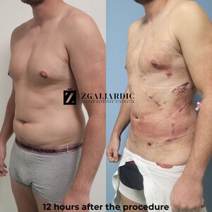 Image of Tummy tuck - Dr. Zgaljardic Clinic