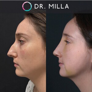 Image of Rhinoplasty