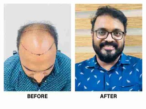 Image of Hair Transplantation Before and After