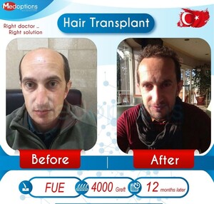 Image of Hair transplant