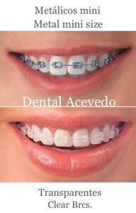 Image of Clear braces