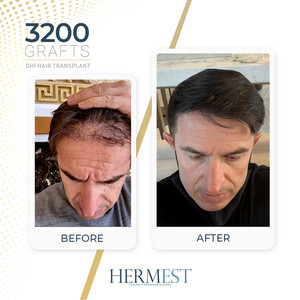 Image of Hermest Hair Transplant Gallery 2