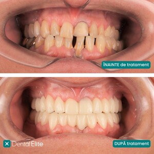 Image of Gum treatment - Dental Elite