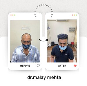 Image of Hair transplant before and after