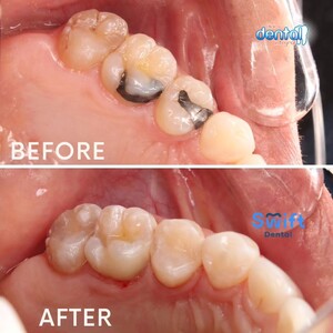 Image of Dental Resin