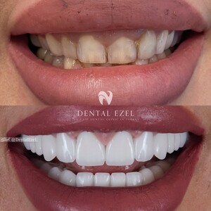 Image of Hollywood smile