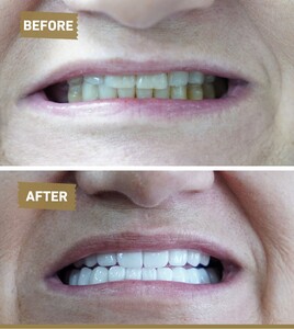 Image of Hollywood smile