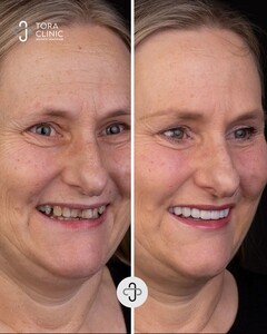 Image of Smile makeover before and after