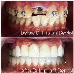 Image of Full Mouth Rehabilitation