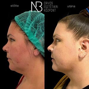 Image of Face lift - New Beauty Medical Aesthetic Center