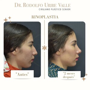 Image of Rhinoplasty 2 months later