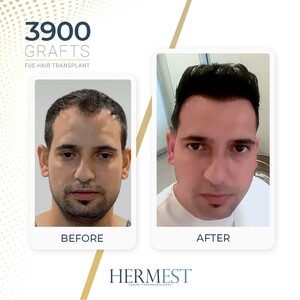 Image of Hermest Hair Transplant Gallery 0