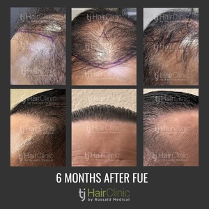 Image of FUE Hair transplant