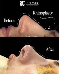 Image of Rhinoplasty