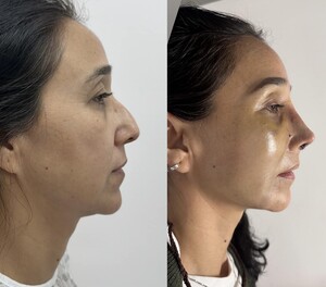 Image of Rhinoplasty