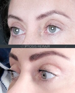 Image of Face and brow lift results