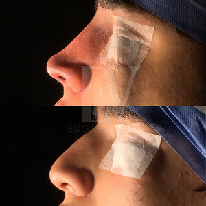 Image of Rhinoplasty