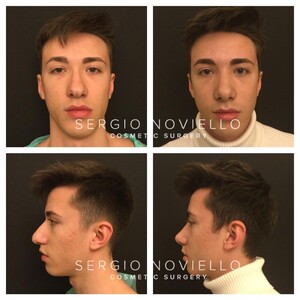 Image of Rhinoplasty before and after