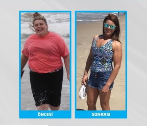 Image of Obesity surgery before and after