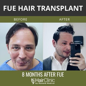 Image of Before and after FUE hair transplant