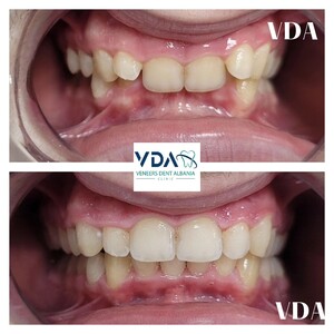 Image of Veneers Dent Albania Clinic Gallery 0