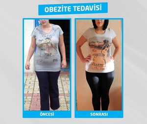 Image of Obesity treatment