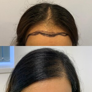 Image of Harris Hair Transplant UK Gallery 2