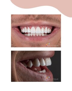 Image of Hollywood smile - Neoclinique