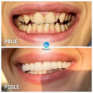 Image of Dental treatment before and after - Micunovic medical