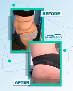 Image of Tummy tuck