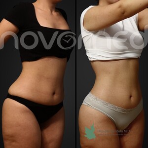 Image of After liposuction