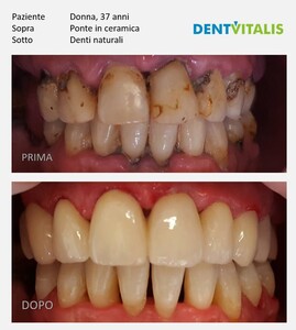 Image of Ceramic crowns