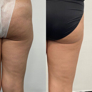 Image of Leg liposuction