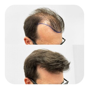 Image of Hair transplant