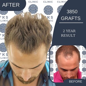 Image of FUE hair transplant