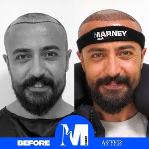 Image of Marney Hair Transplantation Clinic Gallery 2