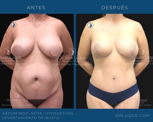 Image of Tummy tuck, liposuction, breast lift