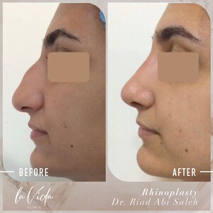 Image of Before and After Rhinoplasty