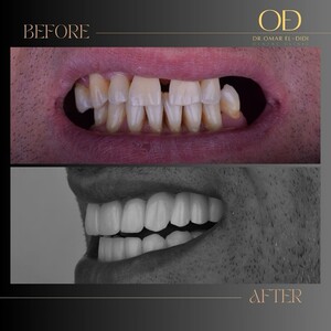 Image of Implants, crowns, and veneers - Dr. Omar El-Didi 